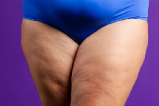 Lipedema e nutrição: estratégias para controlar os sintomas